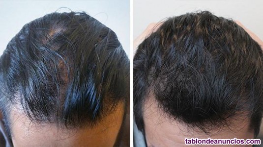Laser dome 110 laser. Terapia laser alopecia. Aga.